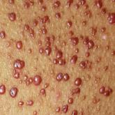 A 12-year-old African-American girl had lesions on her trunk since shortly after birth. Her pediatrician was confident that she would "outgrow" them, but the lesions continue to multiply as she ages. Can you provide a diagnosis image
