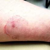 How Do You Solve a Problem Like This Leg Rash?