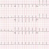 ECG