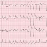 ECG