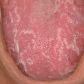 Large, well-delineated, shiny, smooth, erythematous spots on the surface of the tongue