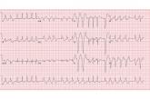 ECG