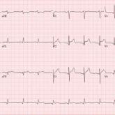 Electrocardiogram