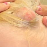 Lipoblastoma of the Scalp in a Child