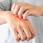 Contact Dermatitis of the Hands