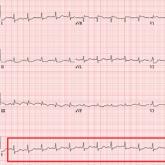 What Do You See in This ECG?