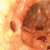 Diverticulitis: A Primer for Primary Care Providers