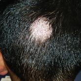 Body-wide, pruritic, papular rash • scalp lesion • excoriation • Dx? 