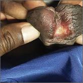 Painless penile ulcer amd tender inguinal lymphadenopathy