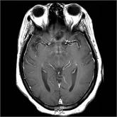 Nausea and vomiting • sensitivity to smell • history of hypertension and alcohol abuse • Dx?