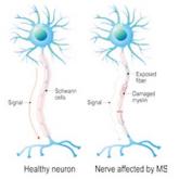 Identifying and Managing MS Relapse