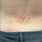 Edematous, reticulated rash on back