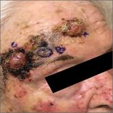Three large lesions on forehead with erythematous papules, plaques on face 