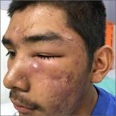 Facial swelling in a 16-year-old boy