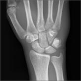 Anteroposterior x-ray view of the wrist on Day 4 after injury