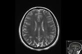 Scattered hyperintense foci were seen in bilateral parietal centrum semiovale