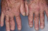 Erosions and ulcerations with hemorrhagic crust on the dorsum of hands and milia on knuckle pads