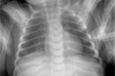 AP chest x-ray of 4-week-old with bilious emesis and abdominal pain