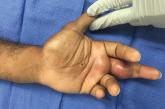 Acute pyogenic flexor tenosynovitis