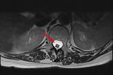 Follow-up MRI revealed a characteristic sign of spinal stroke