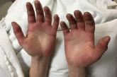 Palmar erythema with acrocyanosis