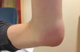 Erythematous left elbow with swollen, fluctuating soft tissue