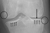 Radiographic findings of knee osteoarthritis