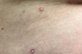 red marks on skin