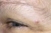 Overlying telangiectasia in eyebrow lesion