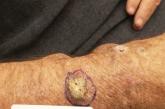 Cutaneous squamous cell carcinoma in a renal transplant recipient