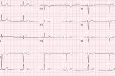 Sinus bradycardia EKG