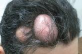 Large nodules on the front of the patient’s scalp