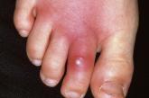 Cellulitis