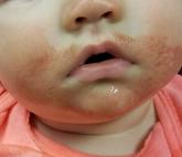 Baby’s Rash Causes Family Feud