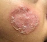 Cheek lesion