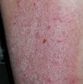 Rash on right leg