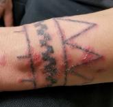 Wrist tattoo with rash