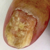 Crusted Scabies Presenting as White Superficial Onychomycosislike Lesions