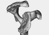 Shoulder Arthroplasty in Cases of Significant Bone Loss: An Overview