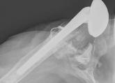 Patient-Specific Implants in Severe Glenoid Bone Loss