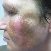 Persistent facial hyperpigmentation