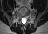 Pseudo-Pedicle Heterotopic Ossification From Use of Recombinant Human Bone Morphogenetic Protein 2 (rhBMP-2) in Transforaminal Lumbar Interbody Fusion Cages