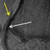 Special Considerations for Pediatric Patellar Instability