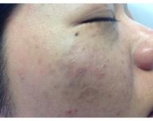 This image shows the vascular component in melasma.