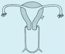 Fig 1c: Imperforate hymen.