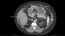 CT of the pancreas with cyst