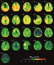 Maps showing the concentrations of tau protein in the brains of patients with traumatic brain injury and healthy controls.