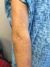 There are numerous papules and plaques with overlying scale on the 17-year-old male's upper arm.