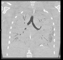 A CT scan of the lungs of the patient with severe lung damage shows a very limited area of ventiilation before his double lung transplant