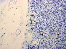 Isolated tumor cells are identified on immunohistochemistry to cytokeratins AE1 and AE3